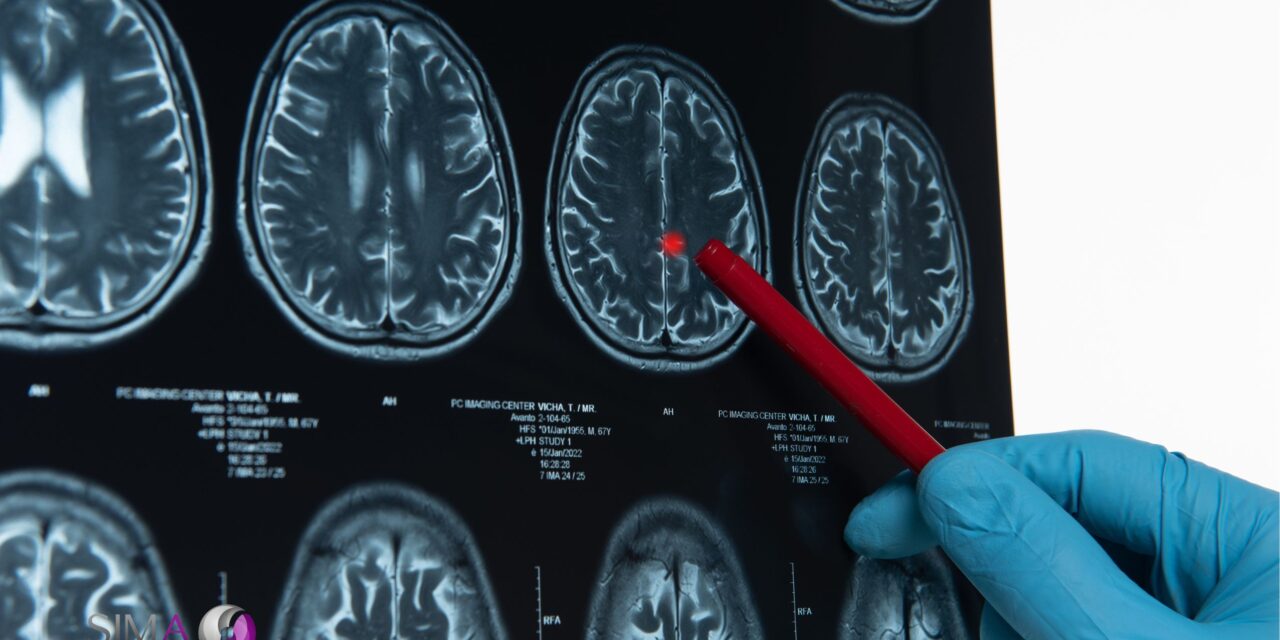 Comprendiendo las enfermedades cerebrovasculares, un vistazo al Cerebro y su Salud