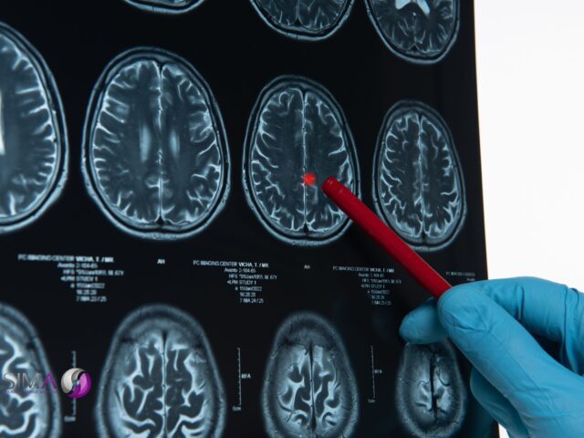 Comprendiendo las enfermedades cerebrovasculares, un vistazo al Cerebro y su Salud